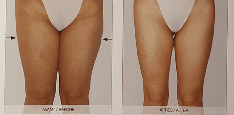 Soin anti cellulite avec LPG