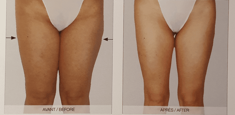 Soin anti cellulite avec LPG