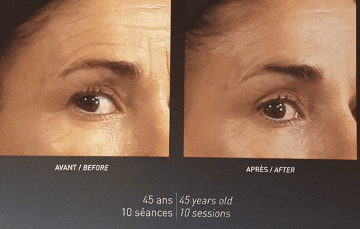 Soin visgage anti-age avec LPG